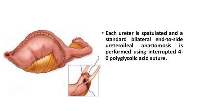 ileal conduit vaginal fistula What if condom gets frozen